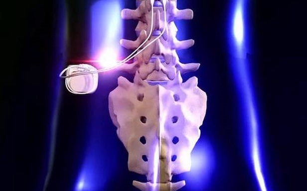 spinal-cord-stimulator